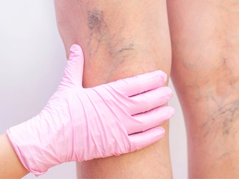 Sclerotherapy Treatment before and after