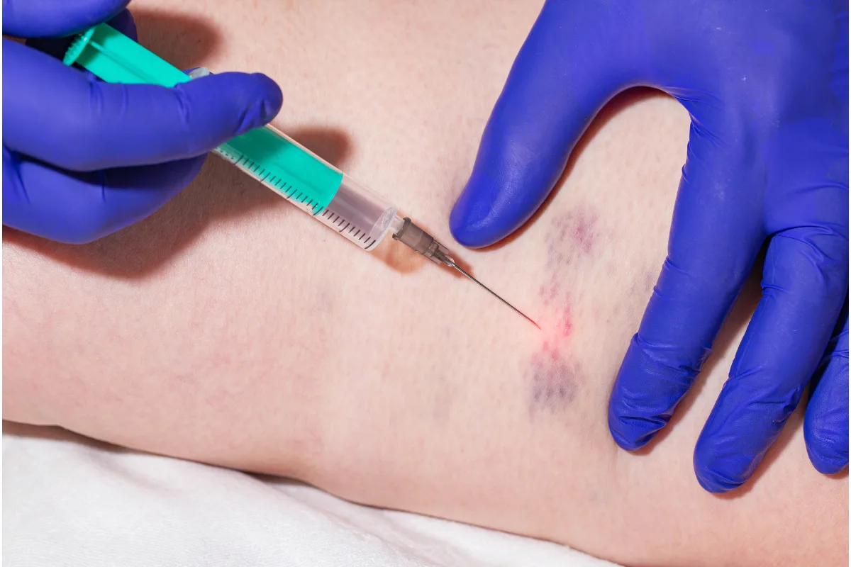 What is Scaclerotherapy?