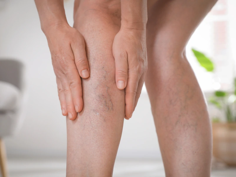 spider vein removal